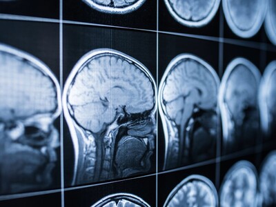 Defendants Accused of Stealing $700K from NJ Traumatic Brain Injury Fund