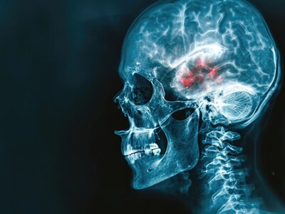 Somerset County Man Convicted in Multi-Million Dollar Fraud Against NJ Traumatic Brain Injury Fund