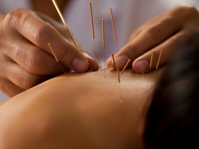 Acupuncturist Sentenced to 34 Months for $9 Million Amtrak Health Care Fraud