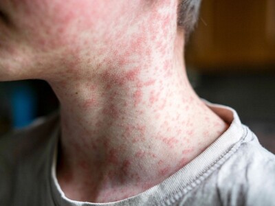 NJDOH Warns of Possible Measles Exposure on Train and Hospital Visit