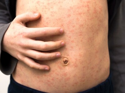NJ Health Officials Warn of Measles Exposure at Newark Airport