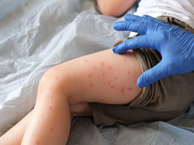 NJ Health Officials Confirm Measles Case in Bergen County, Urge Public to Check Vaccination Status